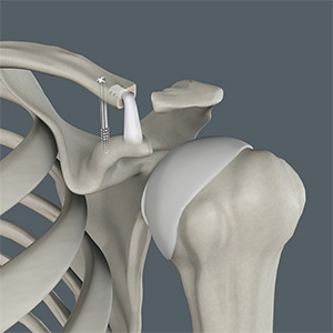 Acromioclavicular (AC) Joint Reconstruction pic 